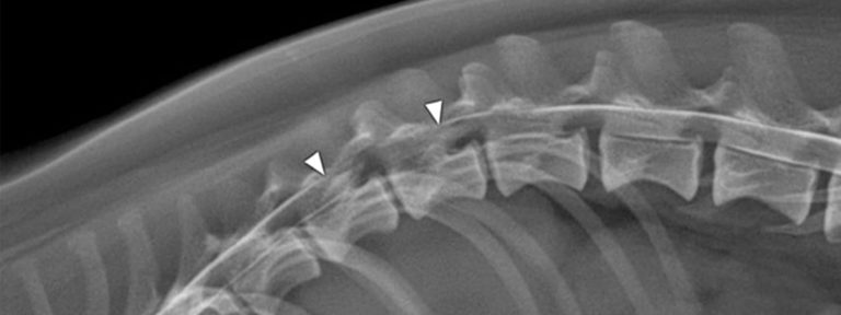 Intervertebral Disc Herniation